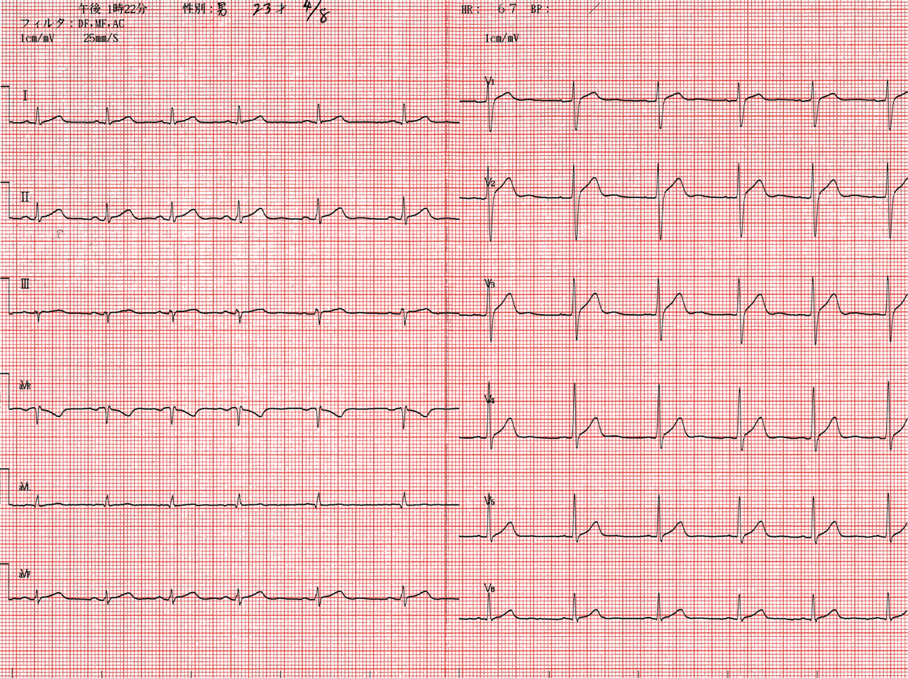 A twelve-lead electrocardiogram trace on a pink grid